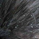 Natural Dandruff Cures