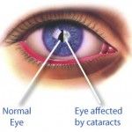 Vitamin C from food tied to lower cataract risk