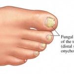 Nail fungus: How to clear up this unsightly infection
