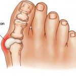 bunion