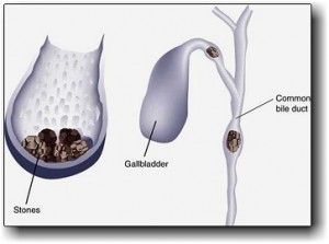 All About Gallstones