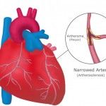 Stop a Heart Attack Naturally