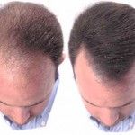 Herbs for Hair Loss