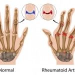 6 Holistic Ways To Treat Rheumatoid Arthritis