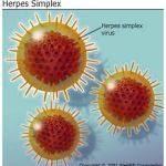 All about genital herpes