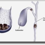 All About Gallstones