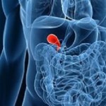 The Ways To Prevent Gallstones From Forming