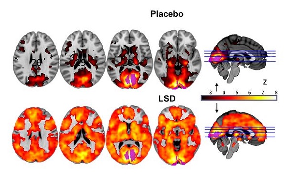 A second image shows different sections of the brain, either on placebo, or under the influence of LSD (lots of orange). Photograph: Imperial/Beckley Foundation