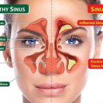 How to Clear Blocked Sinuses, Naturally and Fast!