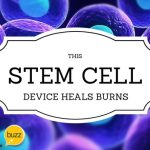 This Stem Cell Device Heals Burns