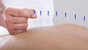 What is Holistic Health: Acupuncture