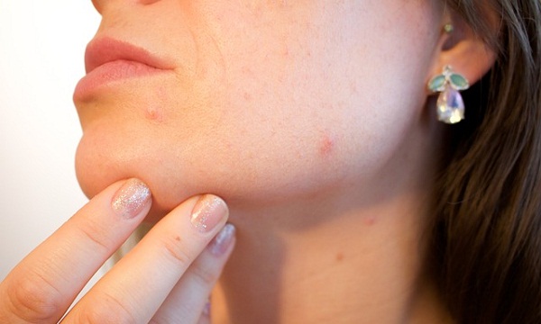 Two different studies showed that using a tea tree oil gel was effective in treating mild to moderate acne. 