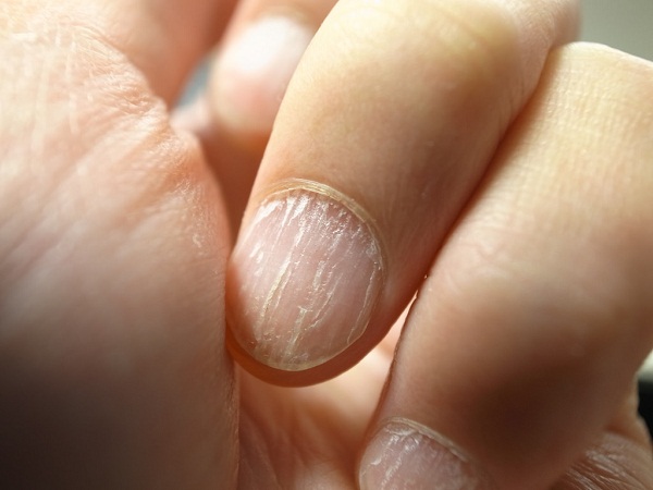 Dry, cracked nails may be a sign of hypothyroidism or indicate a deficiency in vitamins A and C, or in the B vitamin biotin.